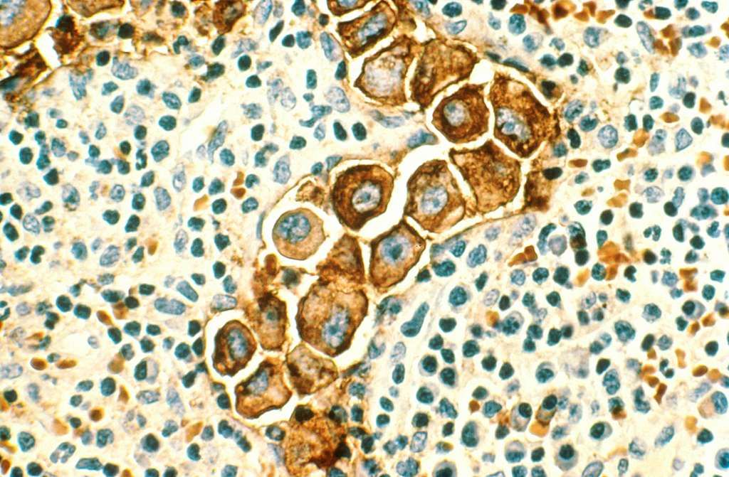 breast cancer in the lymph nodes 816412 10242746183786025781409
